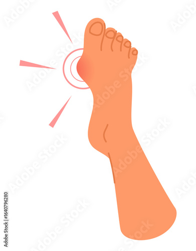 Foot of person with enlarged joint of big toe. Irregular deformity. Pain at bunion. Barefoot human leg. Orthopedic disease. Painful sole joint. Suffer from arthritis. Vector concept