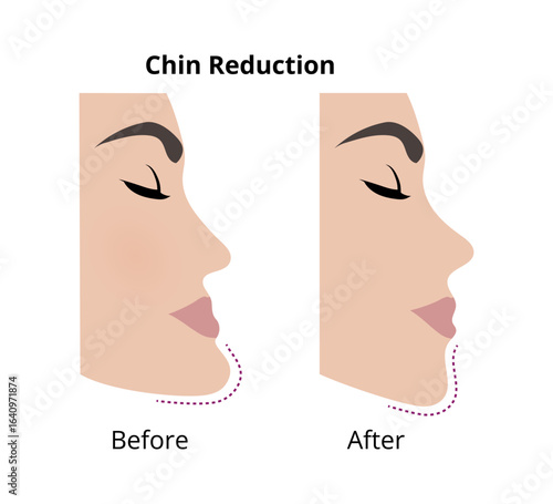 Woman face profile showing chin reduction surgery before and after