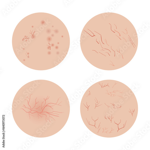 Four Types of Rosacea Showing Different Symptoms on Skin