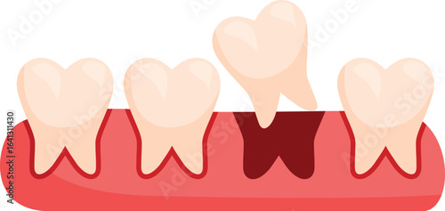 Wisdom tooth growing impacting other teeth and causing gum inflammation, pain and infection