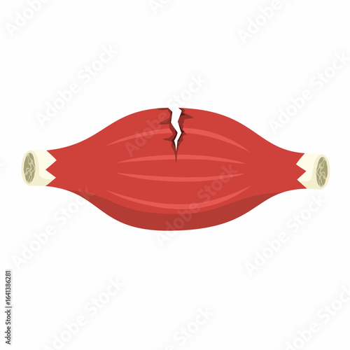 Vector illustration of torn muscle, injured muscle or ruptured muscle on white background