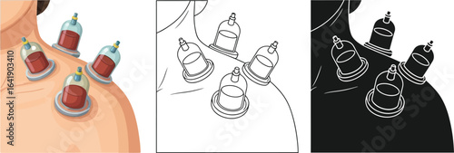 Cupping therapy benefits and side effects treatment for pain editable