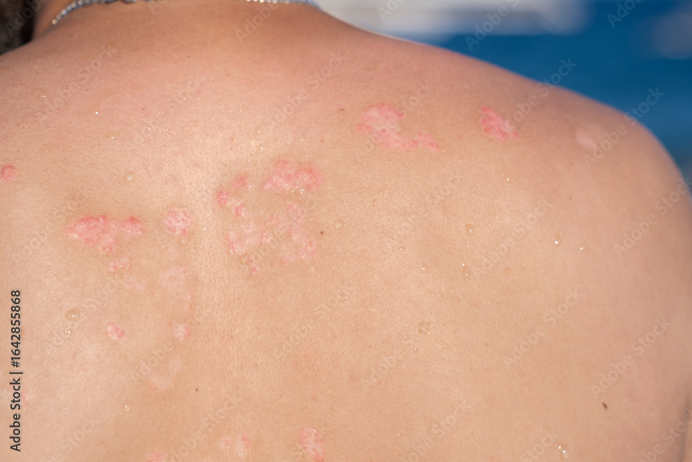 Fototapeta premium Skin Condition Visible on Back With Red Patches Indicating Psoriasis During Warm Weather
