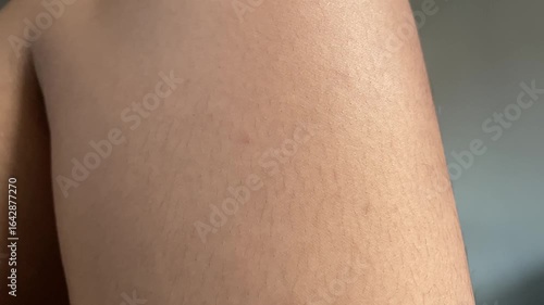 Close-up view of a person's leg with noticeable stretch marks.