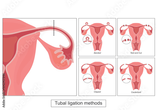 Tubal ligation is surgery to close a woman's fallopian tubes.
