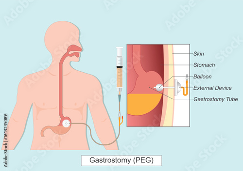 Gastrostomy or PEG Tube.