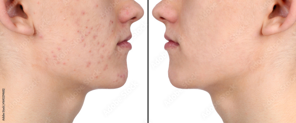 Obraz premium Man with acne problem showing his face before and after skin care treatment, closeup. Collage