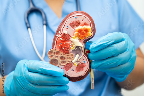 Chronic kidney disease, doctor with model for treatment urinary system, urology, Estimated glomerular filtration rate eGFR.