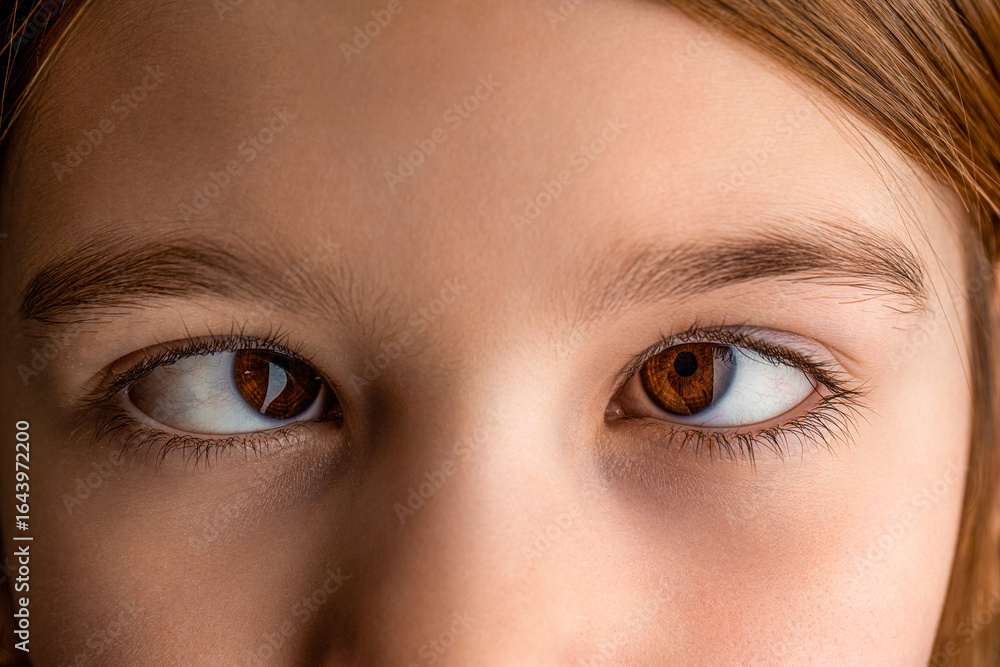 Naklejka premium Little patient strabismus, treatment ophthalmic diseases. Female eyes with strabismus. Hypertropia. Strabismus. Closeup part child's face, eyes girl