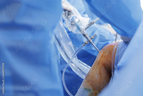Photos Knee arthroscopy with PCL reconstruction using arthroscope in a sterile operatin