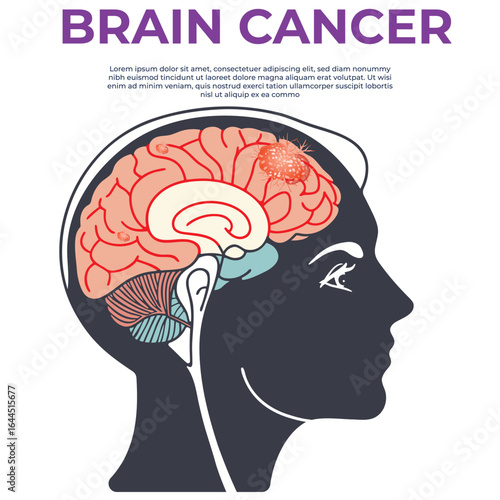 Brain Cancer Symptoms Causes and Treatment Options
