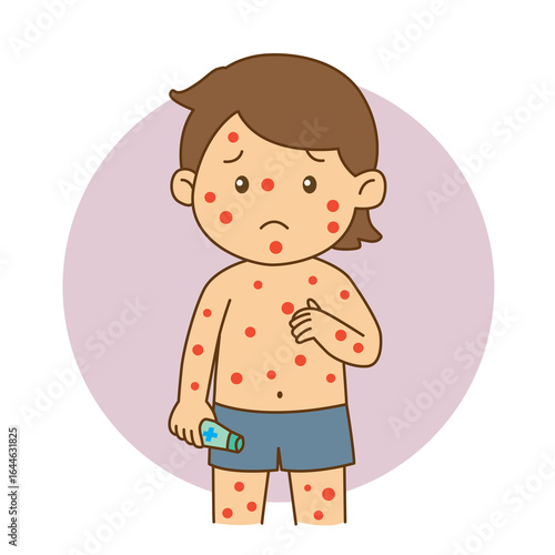 Fotografie A boy has chickenpox and has red bumps all over his body, Illustration cartoon o