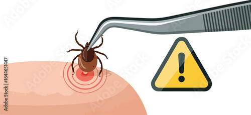 Tick Bite Removal from Skin with Tweezers and Warning Sign.