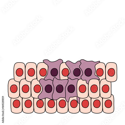 cancer cells illustration, hyperplasia and dysplasia. Mutated cells. The spread of cancer cells. Medical vector illustration, poster or science study.