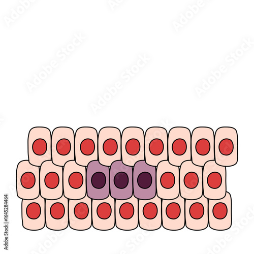 Illustration of mutated cells, from cancer to malignant tumors, hyperplasia, and dysplasia. Spread of cancer cells. Medical vector illustration, poster, or science study.