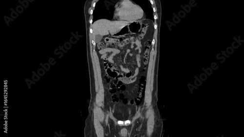 abdomen CT scan 3d rendering showing kidney stone and Dj stent JJ stent (down left) in a urinary system. The stent has been inserted in the patient's ureter to keep it open
