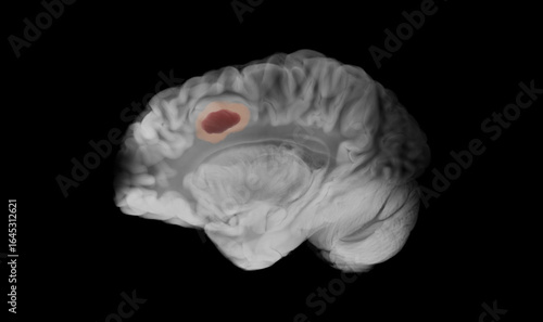 Sagittal view of a human brain in grayscale showing a glioblastoma as a dark maroon mass with a pale pink halo in the left frontal lobe against a black background.