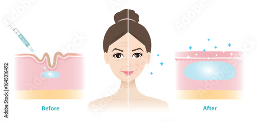 Comparison of before and after filler injection under the skin on woman face vector illustration. Cross section of dermal filler injected to correct the lines and wrinkles. Medical and beauty concept.