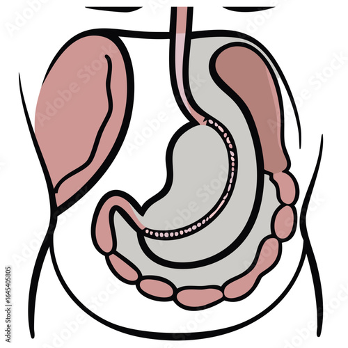 Gastric Sleeve Surgery Anatomy on transparent background