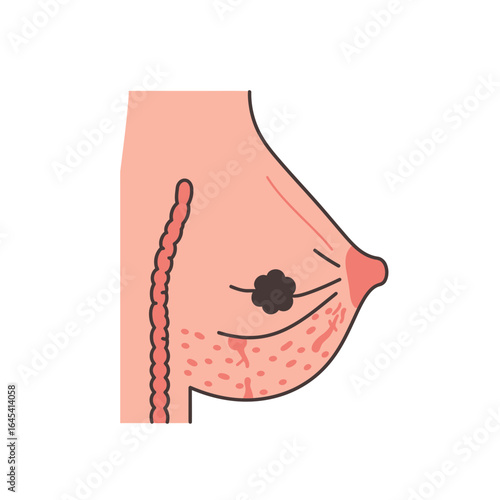 Breast Cancer Awareness Illustration: A medical illustration showcasing a simplified representation of a breast affected by a tumor.