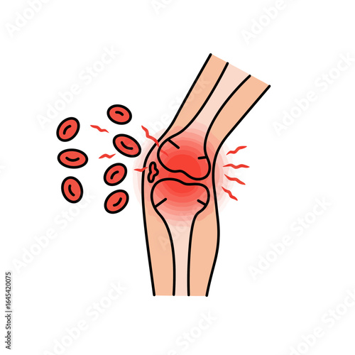 Knee Pain Illustrated: A medical illustration depicts an inflamed knee joint with red blood cells, visually representing the condition of pain.