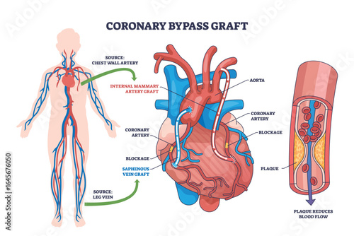 Coronary bypass graft surgery is shown with heart, blood vessels, and graft routes to bypass blocked arteries. Outline diagram
