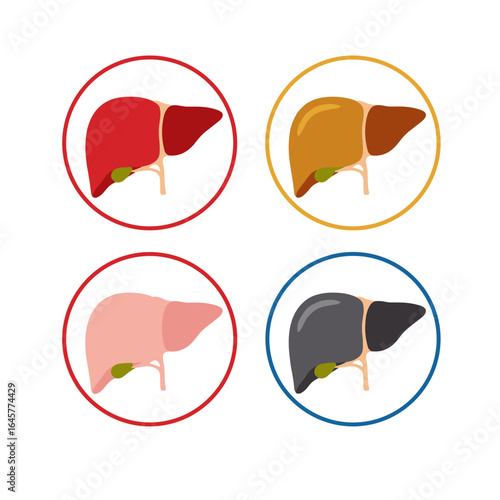 Illustrations of human liver health and disease stages represented by color variations in circles