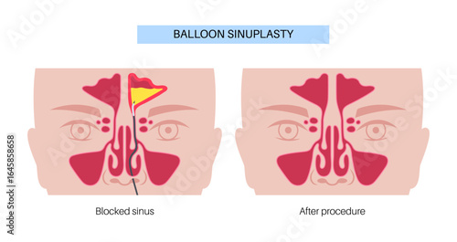 Balloon sinuplasty poster