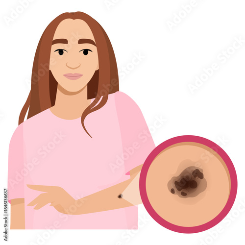 Young woman with melanoma and magnifying glass