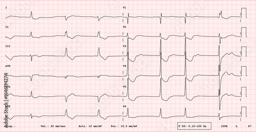 ECG Electrocardiogram Showing Digital Intoxication Pattern with Characteristic ST Segment Depression and Sagging Effect on 12-Lead Medical Diagnostic Chart