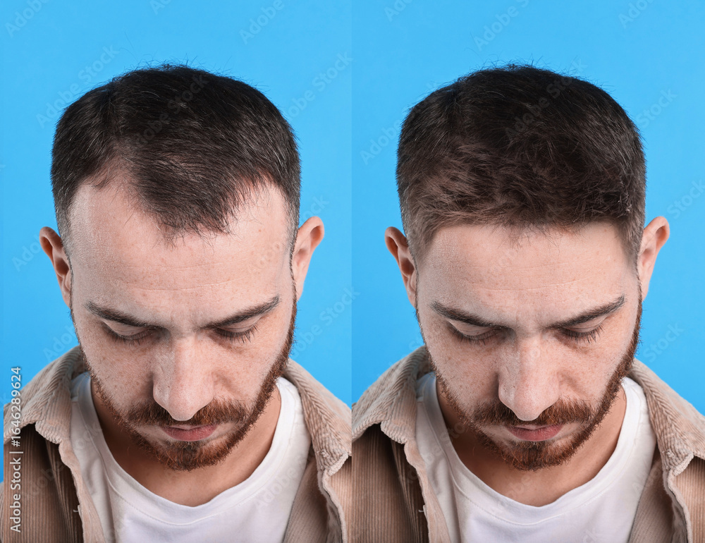 Fototapeta premium Man before and after hair treatment on blue background, collage
