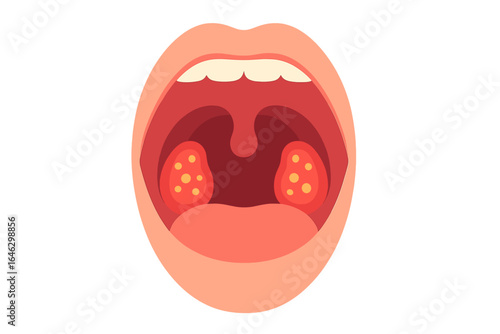 Human mouth illustration showing tonsils and throat anatomy inflamed tonsils