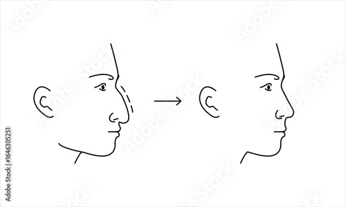 Outline vector illustration showing rhinoplasty of noce hump of a young man, face profile picture before and after.