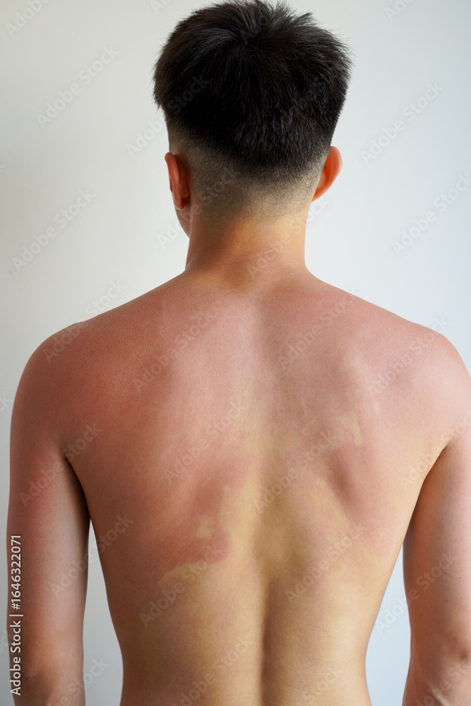 Fototapeta premium 真っ赤に日焼けした若い男性の背中の後ろ姿