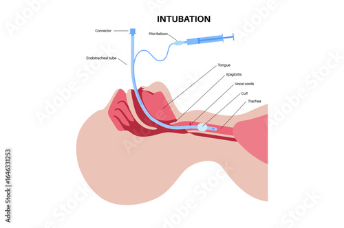 Intubation medical procedure