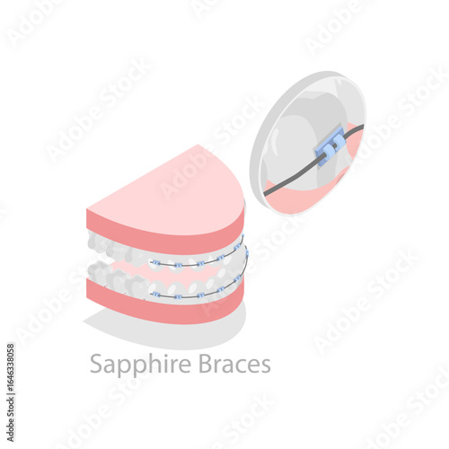 3D Isometric Flat Vector Illustration of Dental Teeth Braces Types, Orthodontic Options for Teeth Straightening. Item 5