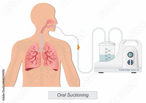 Oral suction is suction that is applied to removing mucous secretions.