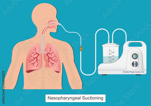 Nasogastric (NG) suctioning is the process