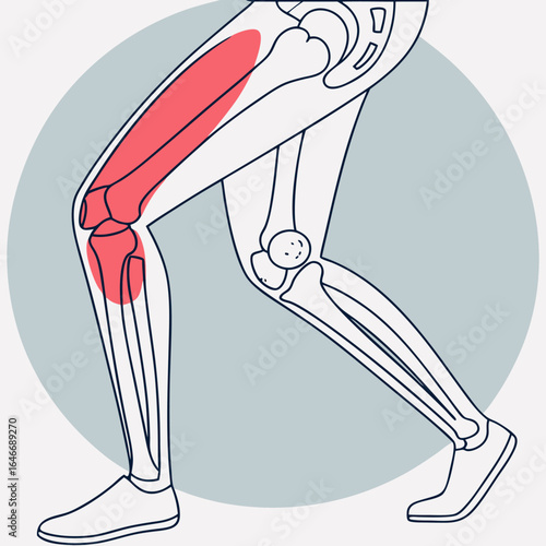 Quadriceps Muscle Pain Illustration – Anatomy of Front Thigh and Knee