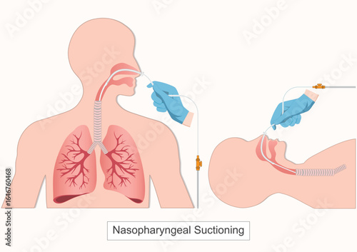 Nasopharyngeal suctioning is a medical procedure.