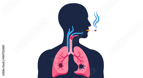 Smoking damages your respiratory system causing lung cancer and other diseases