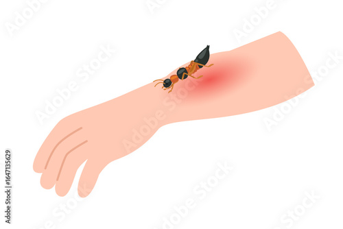 Paederus beetle make skin allergy concept
