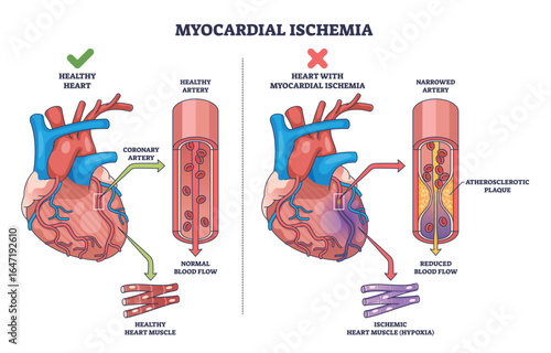 Myocardial ischemia is shown with a heart, narrowed artery, and reduced blood flow compared to a healthy heart. Outline diagram
