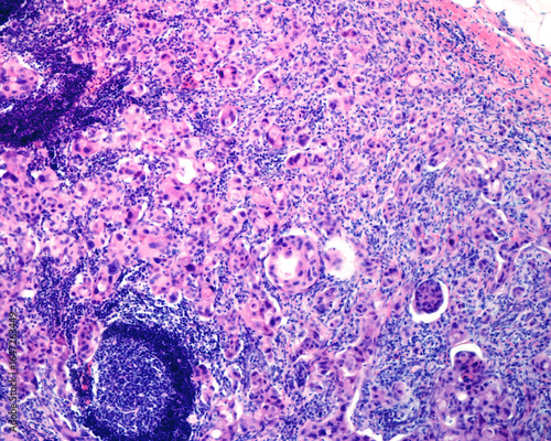 Fotografie Lymph node. Breast carcinoma metastasis