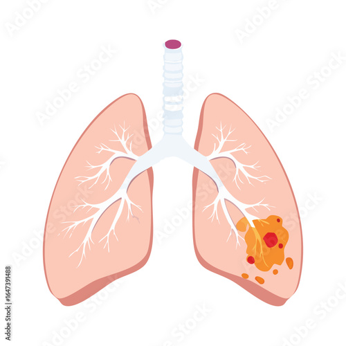 Medical illustration of human lungs with a tumor, depicting lung cancer and disease.