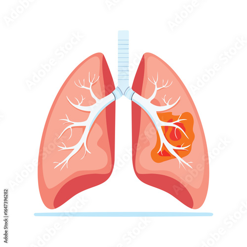 Medical illustration depicting human lungs with a cancerous tumor, highlighting the disease's impact.