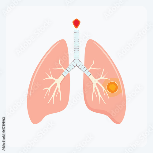 Medical illustration of human lungs, showing the respiratory system and a cancerous tumor.