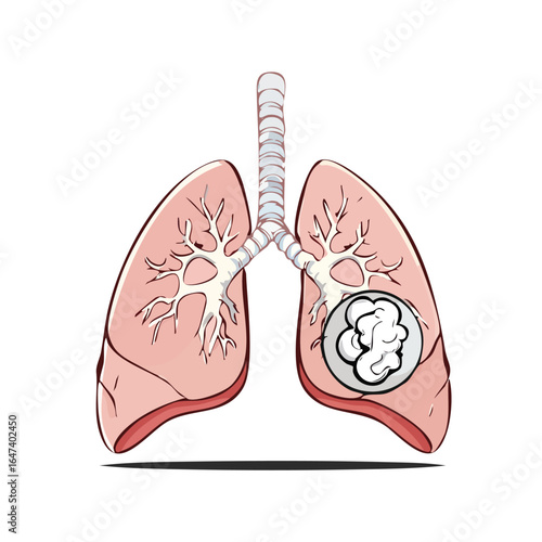 Medical illustration depicting human lungs with a cancerous tumor, highlighting respiratory system.