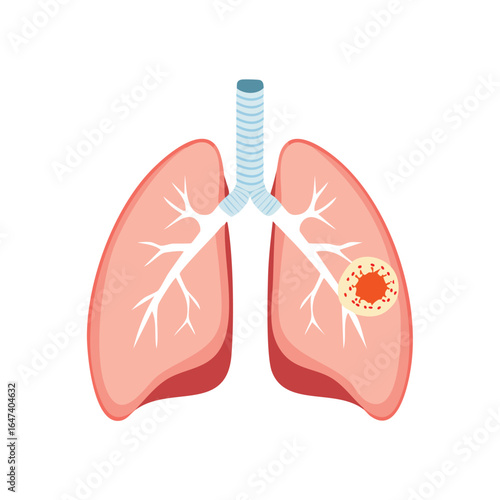 Anatomical illustration of human lungs depicting a cancerous tumor, highlighting respiratory system details.