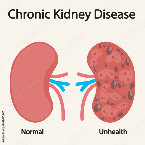 Chronic kidney disease vector illustration showing key symptoms like fatigue, swelling, nausea, and related conditions such as diabetes and hypertension.